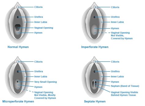 hymen pictures|Hymen: Overview, Function & Anatomy